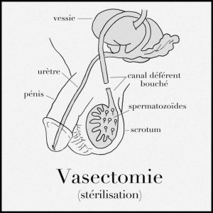 vasectomie-800x800.jpg