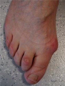 Hallux-valgus-pied-deforme.jpg