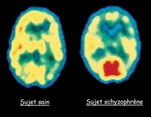 Schizophrenie-observee-par-Pet-scan-1.jpg