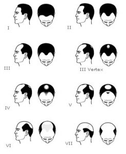 redim-classification-de-norwood-hamilton-pour-la-calvitie-masculine-elx6z.jpg