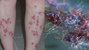 morgellons-300x168.jpg